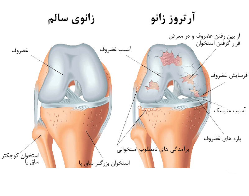 علائم آرتروز زانو چیست؟